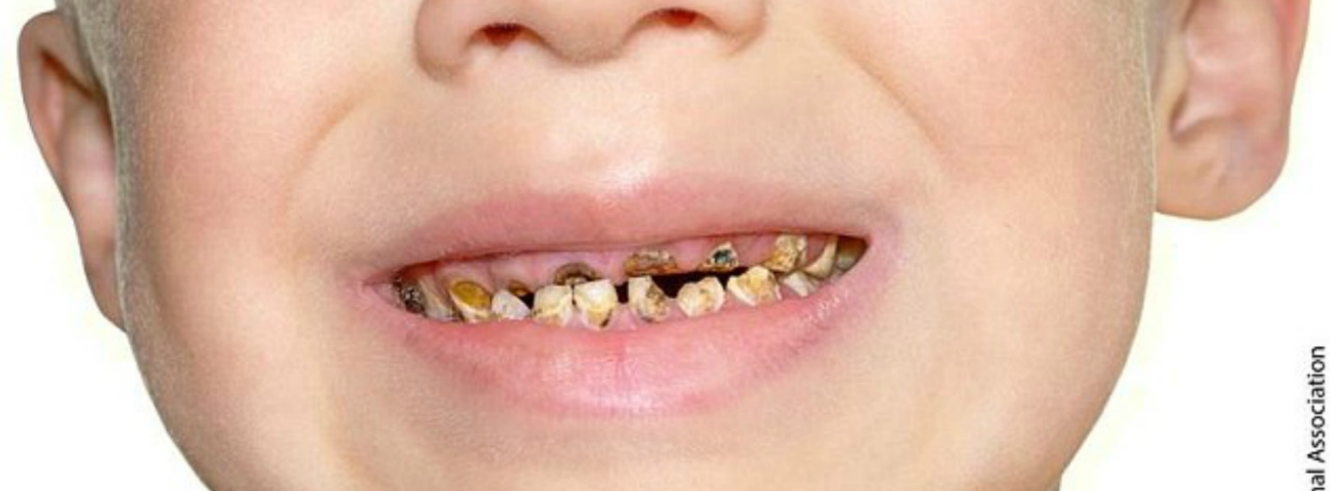foto de dientes podridos