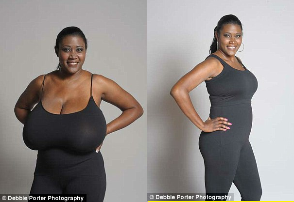 From 36NNN to DD Cup Size; A 40-Year-Old Woman's Journey To Remove 15lbs Of  Tissue From Her Breast