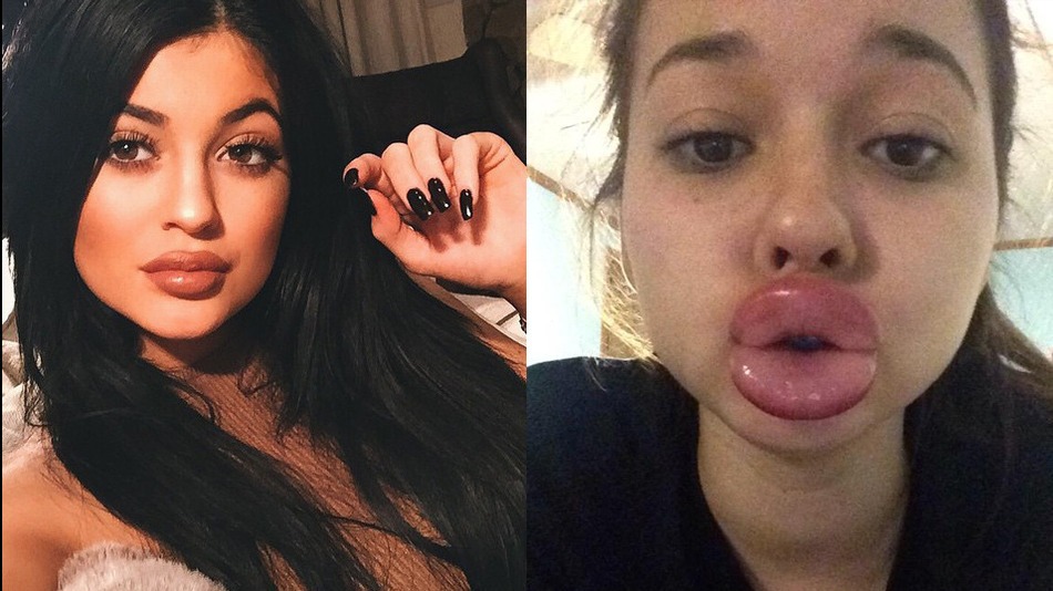 Kylie Jenner Lip Challenge Aftermath